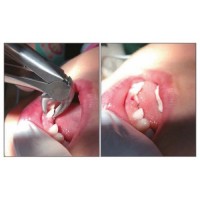"Легкие" щипцы для детей 3259s Easy Forceps For Children