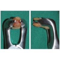 "Легкие" щипцы EASY FORCEPS 3253